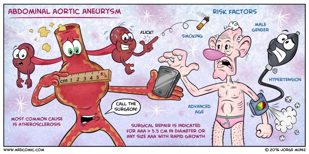 Abdominal-Aortic-Aneurysm