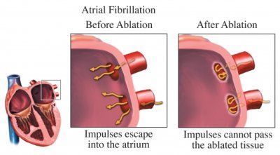 AF atrial-fibrillation-ablation