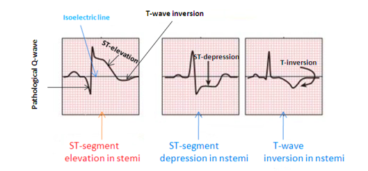 tro inf-nstemi-vs-stemi-ECG