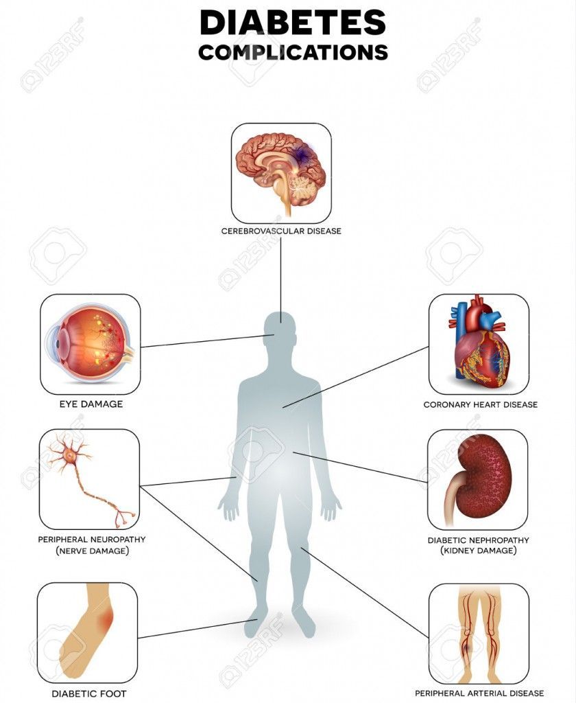 Diabetes mellitus affected areas. Diabetes affects nerves, kidneys, eyes, vessels, heart and skin.