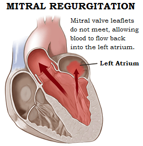 mr-Mitral-Regurgitation