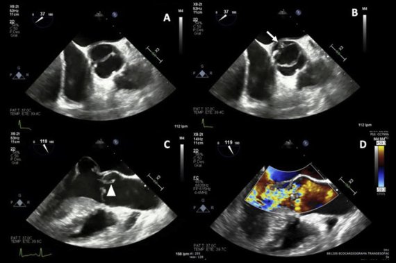 bav TEE-A-B-Aortic-valve-short-axis-view-bicuspid-aortic-valve-with-posterior-thickening
