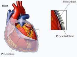 Η ΠΕΡΙΚΑΡΔΙΤΙΔΑ ΚΑΙ Η ΣΥΛΛΟΓΗ ΥΓΡΟΥ ΣΤΟ ΠΕΡΙΚΑΡΔΙΟ | Καρδιολογία