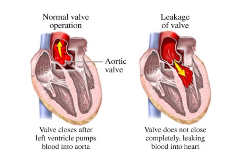 aortic-regurgitation