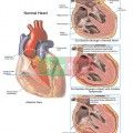 Accurately depicts the process of cardiac tamponade (hemorrhage within the pericardium) with subsequent ventricular collapse. Shows normal heart and the pericardial sac (pericardium). Progression of tamponade: 1. Normal heart, ventricles, pericardial space and pericardial sac; 2. Initial condition with blood hemorrhaging between the heart wall and the pericardial sac; 3. Ultimate condition with the collapse of the ventricles and the blood stopping the heart from beating