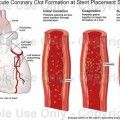 stent θρόμβωσης