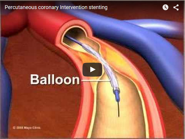 εικόνα απο βίντεο που εξηγεί τη διαδικασία εισαγωγής του stent
