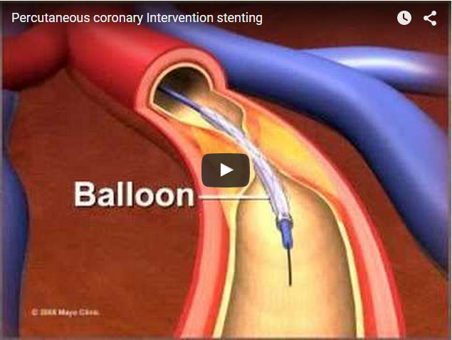 ΝΕΟ STENT ΓΙΑ ΤΗΝ ΣΤΕΦΑΝΙΑΙΑ ΝΟΣΟ