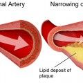 στένωση αρτηριών