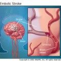 embolic stroke