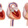 tavr Transcatheter-Aortic-Valve-Replacement-TAVR）