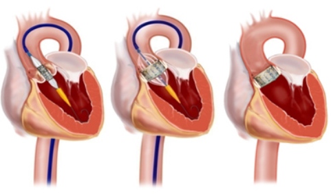 TAVI (ή TAVR) ΓΙΑ ΘΕΡΑΠΕΙΑ ΤΗΣ ΣΤΕΝΩΣΗΣ ΤΗΣ ΑΟΡΤΙΚΗΣ ΒΑΛΒΙΔΑΣ  ΣΕ ΗΛΙΚΙΩΜΕΝΟΥΣ