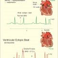 artial ectopic beat