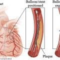 απεικόνιση λειτουργίας stent