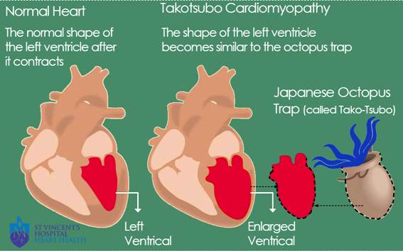 Takotsubo_Cardiomyopathy_final_image