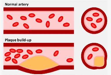 tri The-atherosclerotic-plaque-Illustration-depicting-the-progression-of-plaque-formation