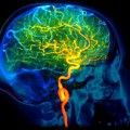 cerebrovascular-disease_342x198_C0071980