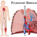 tve_pulmonary_embolism