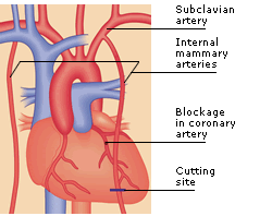 ΠΡΟΤΙΜΟΤΕΡΗ Η ΕΓΧΕΙΡΗΣΗ, ΤΟ STENT ή ΤΑ ΦΑΡΜΑΚΑ  ΣΕ ΣΤΑΘΕΡΗ ΣΤΕΦΑΝΙΑΙΑ ΝΟΣΟ ?