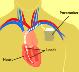 VIM pacemakers-what-you-should-know-1745231_v2-da71dbec46b345308dd2fcbb65cc638b