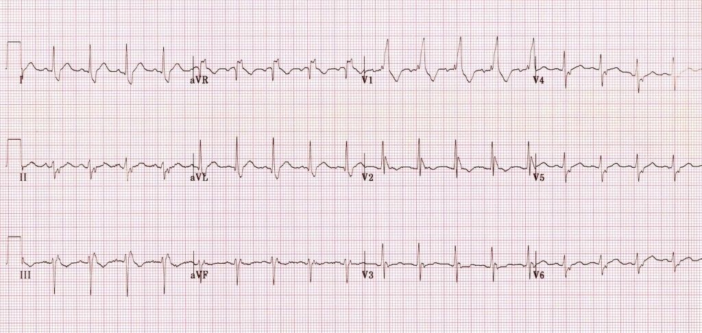 Bifascicular1