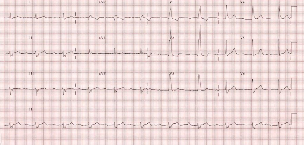 trifascicular-2