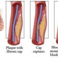 Mi yocardial Infarction