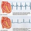 tachy artial-fibrillation