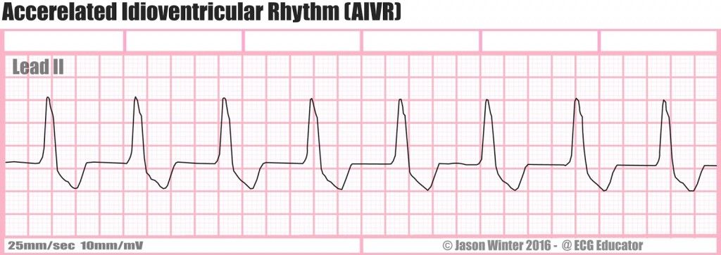 arr 22) AIVR STRIP