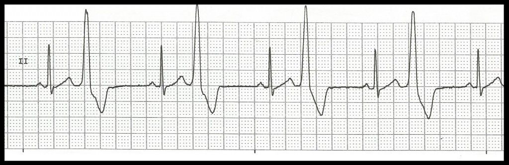 arr NSR with bigeminal PVCs