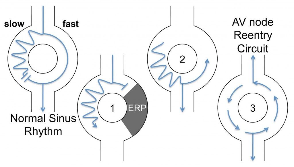 arryt AV_reentry_circuit