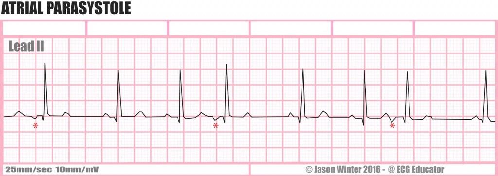 arryth  ATRIAL PARASYSTOLE