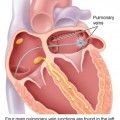 κολπική μαρμαρυγή και ablation