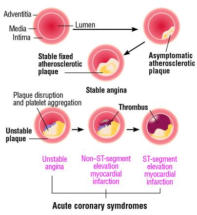 ΔΙΑΒΗΤΗΣ ΚΑΙ ΛΙΠΙΔΙΑ (ΧΟΛΗΣΤΕΡΙΝΗ LDL, MH HDL, APO B KAI ΤΡΙΓΛΥΚΕΡΙΔΙΑ)