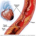 chol ds01179_im03129_mcdc7_myocardialischemia_jpg