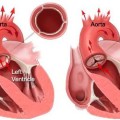 as st-severe-aortic-stenosis