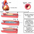 tripl Fig-2-Angioplasty-with-stent-implantation-procedure-Schematic-illustration-Figure