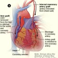 CABG Illustration