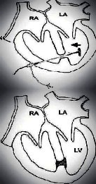 VSD Schematic2-of-the-procedure-RA-right-atrium-LA-left-atrium-RV-right-ventricular-LV