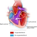 Mount Sinai Health System, Congenital Heart Defects