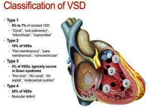 vsd congenital-heart-disease-by-dr-shaymaa-fayad-el-nasr-hospital-port-said-24-638