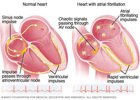 ATRIAL-FIBRILLATION-mcdc11_heartforafib