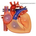 coa #### coarctation-of-the-aorta-illustration-canonical-16x9