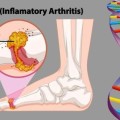 Gout -Diet-News-722x406