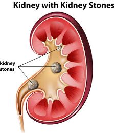 96111982 - human anatomy diagram with kidney stones illustration