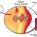 gout ############## Discover-How-You-Can-Control-Uric-Acid-Levels