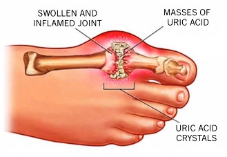 gout What-Is-Gout