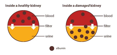 KIDN damaged_vs_healthy_kidney