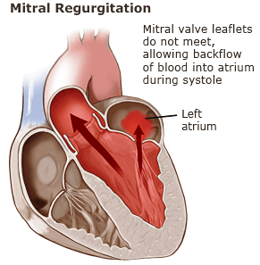 mr progression-mitral-regurgitation