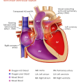 tga transposition-of-the-great-arteries-with-intact-ventricular-septum-illustration-773px_0